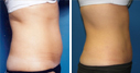 Before & After Photos